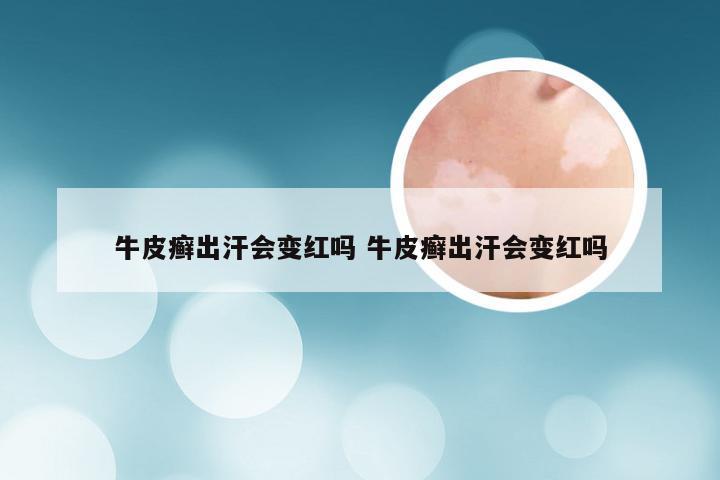 牛皮癣出汗会变红吗 牛皮癣出汗会变红吗