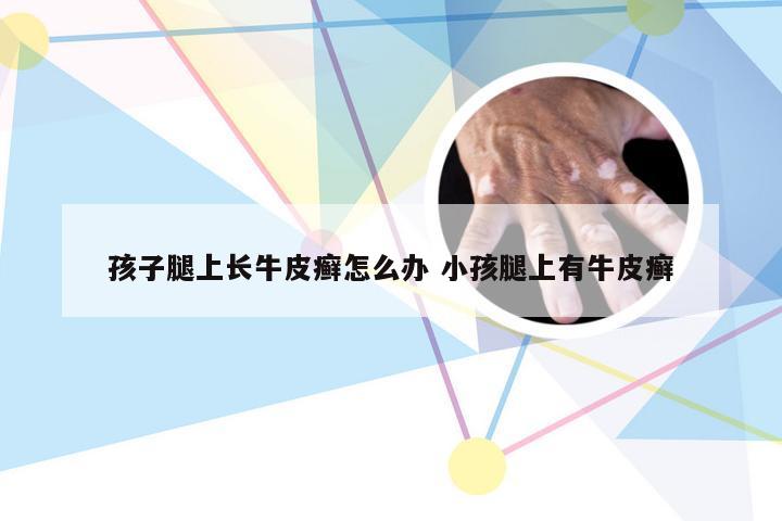 孩子腿上长牛皮癣怎么办 小孩腿上有牛皮癣