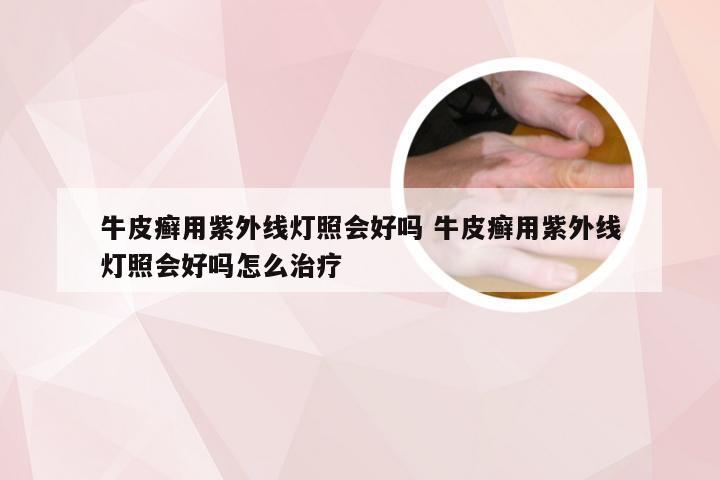 牛皮癣用紫外线灯照会好吗 牛皮癣用紫外线灯照会好吗怎么治疗