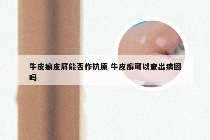 牛皮癣皮屑能否作抗原 牛皮癣可以查出病因吗
