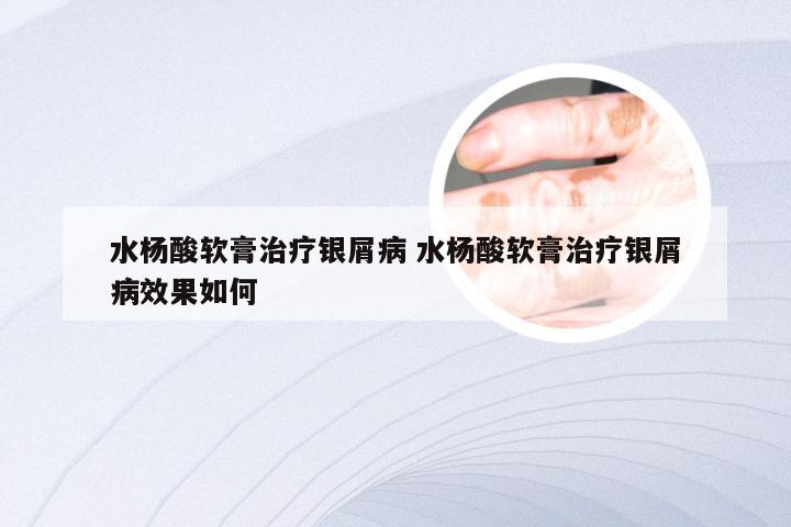 水杨酸软膏治疗银屑病 水杨酸软膏治疗银屑病效果如何