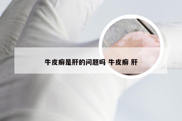 牛皮癣是肝的问题吗 牛皮癣 肝