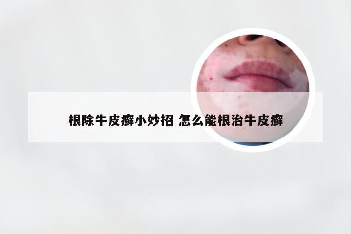 根除牛皮癣小妙招 怎么能根治牛皮癣