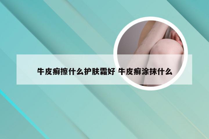 牛皮癣擦什么护肤霜好 牛皮癣涂抹什么