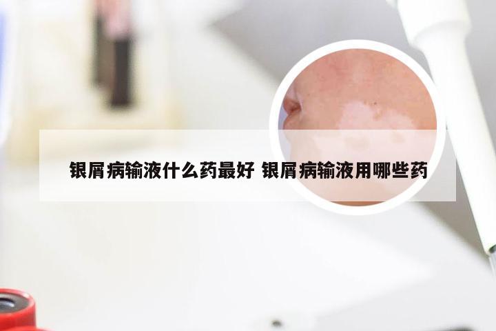 银屑病输液什么药最好 银屑病输液用哪些药