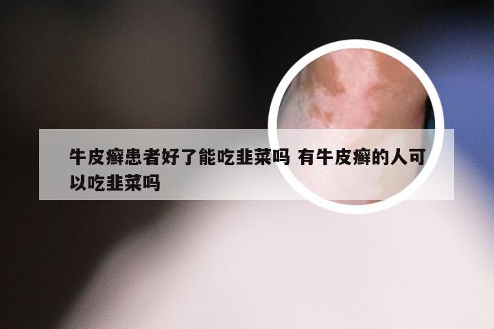 牛皮癣患者好了能吃韭菜吗 有牛皮癣的人可以吃韭菜吗