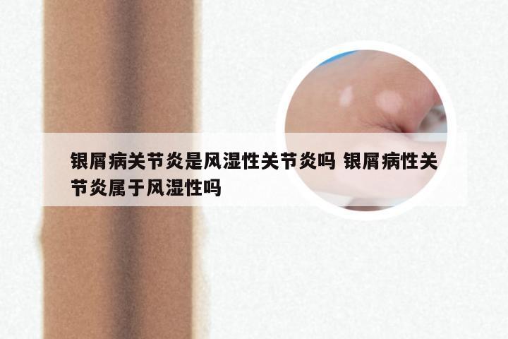 银屑病关节炎是风湿性关节炎吗 银屑病性关节炎属于风湿性吗