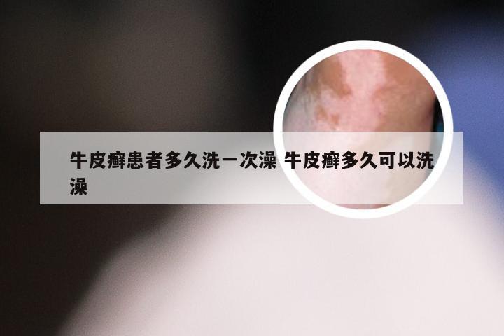 牛皮癣患者多久洗一次澡 牛皮癣多久可以洗澡
