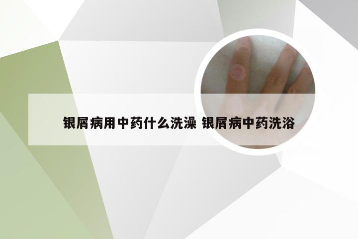 银屑病用中药什么洗澡 银屑病中药洗浴