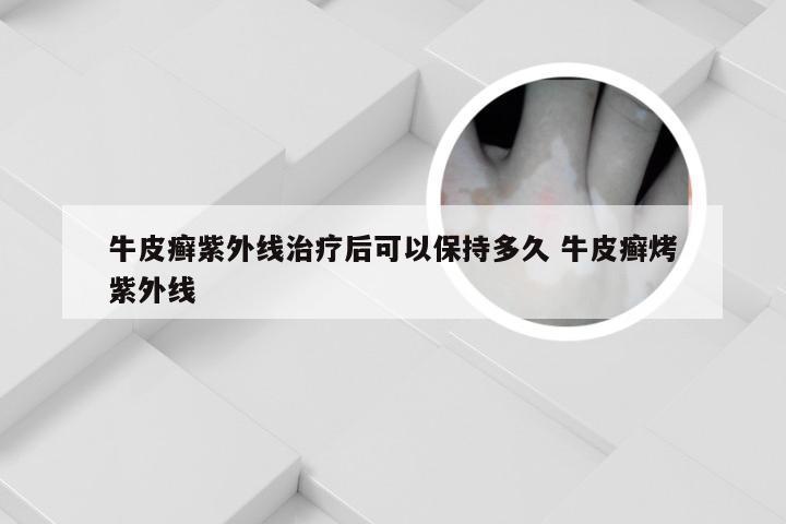 牛皮癣紫外线治疗后可以保持多久 牛皮癣烤紫外线