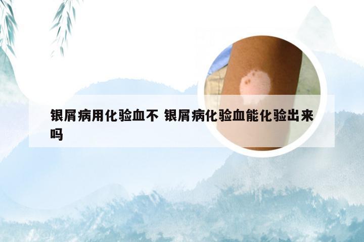 银屑病用化验血不 银屑病化验血能化验出来吗