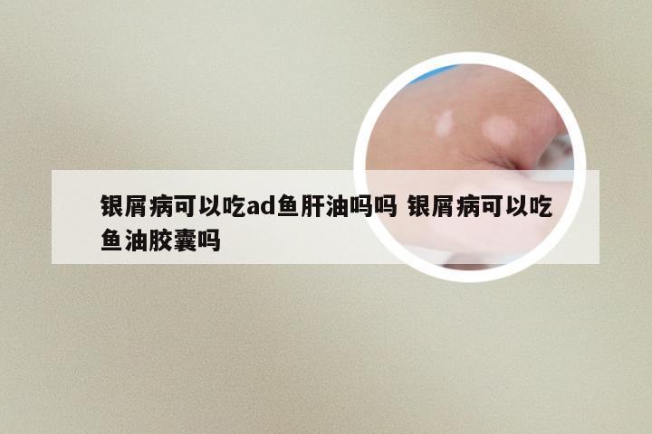 银屑病可以吃ad鱼肝油吗吗 银屑病可以吃鱼油胶囊吗