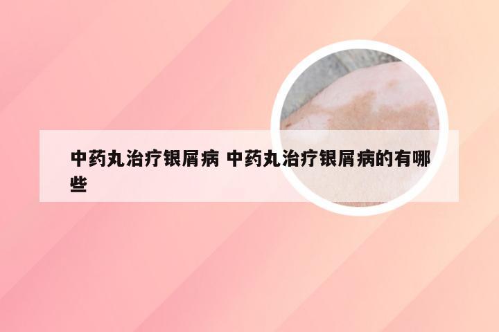 中药丸治疗银屑病 中药丸治疗银屑病的有哪些