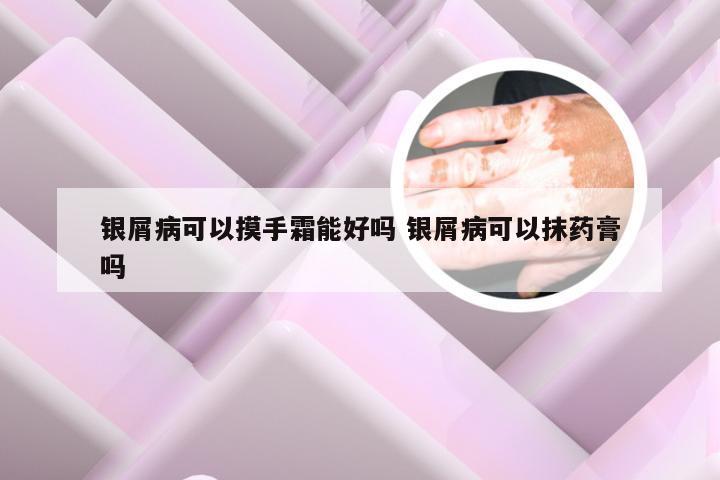 银屑病可以摸手霜能好吗 银屑病可以抹药膏吗