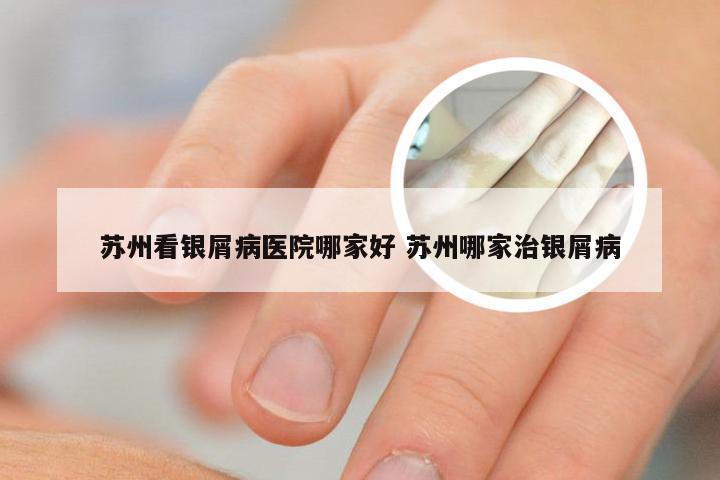 苏州看银屑病医院哪家好 苏州哪家治银屑病