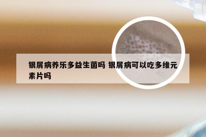 银屑病养乐多益生菌吗 银屑病可以吃多维元素片吗