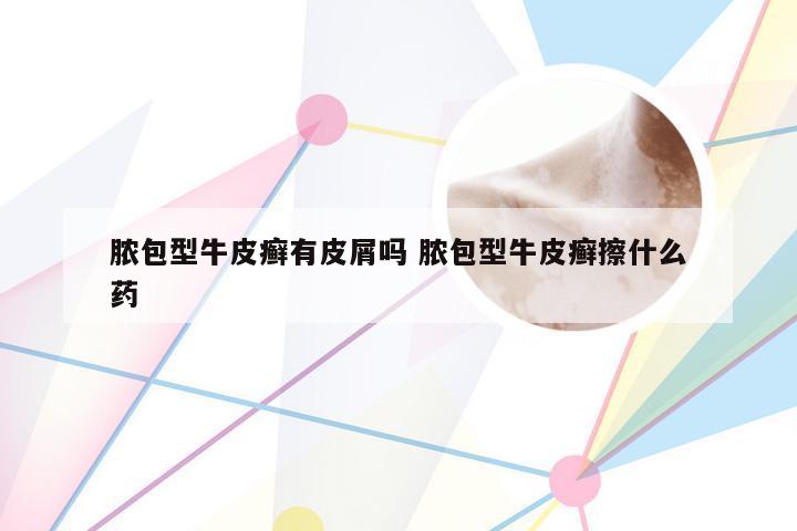 脓包型牛皮癣有皮屑吗 脓包型牛皮癣擦什么药
