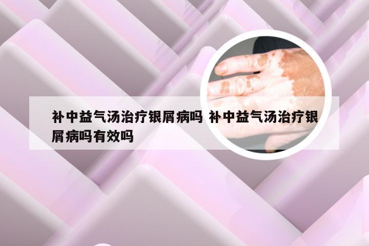补中益气汤治疗银屑病吗 补中益气汤治疗银屑病吗有效吗