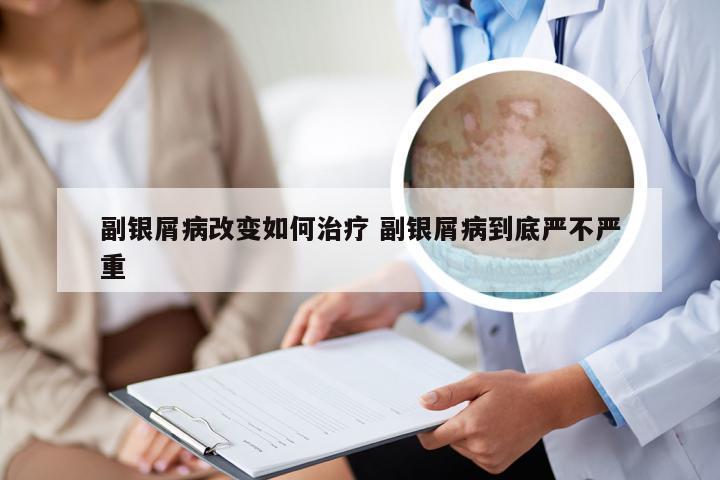 副银屑病改变如何治疗 副银屑病到底严不严重