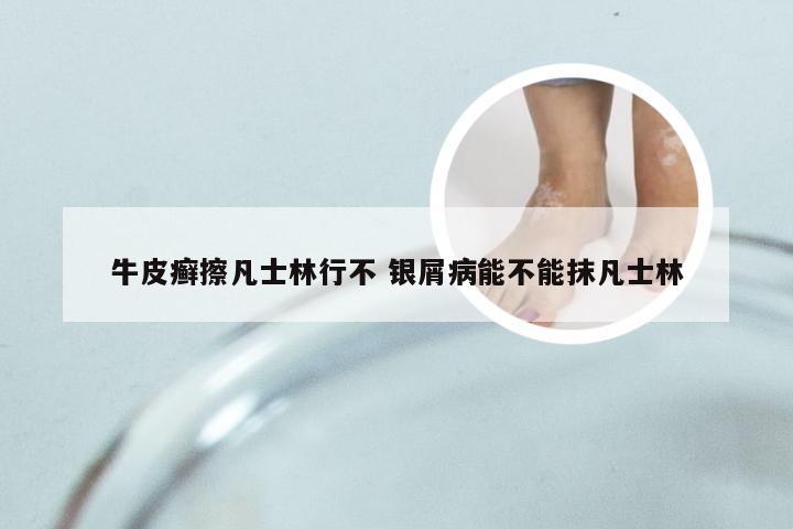 牛皮癣擦凡士林行不 银屑病能不能抹凡士林