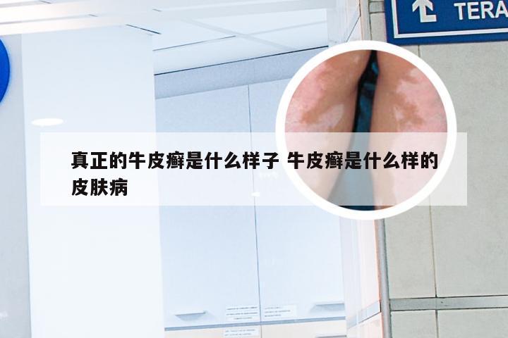 真正的牛皮癣是什么样子 牛皮癣是什么样的皮肤病