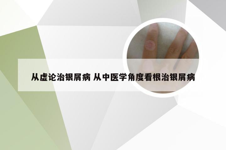 从虚论治银屑病 从中医学角度看根治银屑病