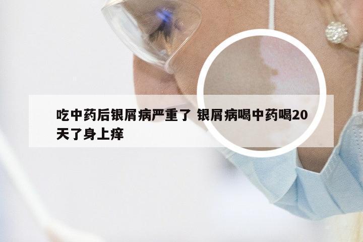 吃中药后银屑病严重了 银屑病喝中药喝20天了身上痒