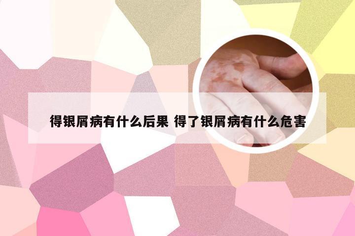 得银屑病有什么后果 得了银屑病有什么危害