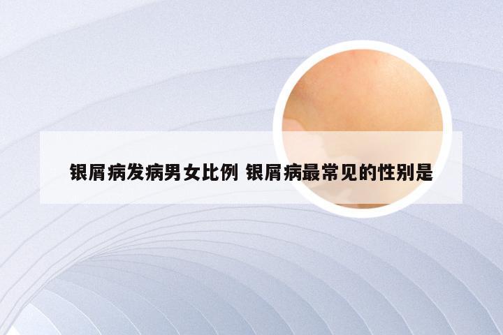 银屑病发病男女比例 银屑病最常见的性别是