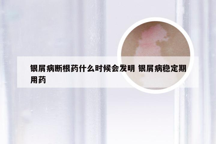银屑病断根药什么时候会发明 银屑病稳定期用药
