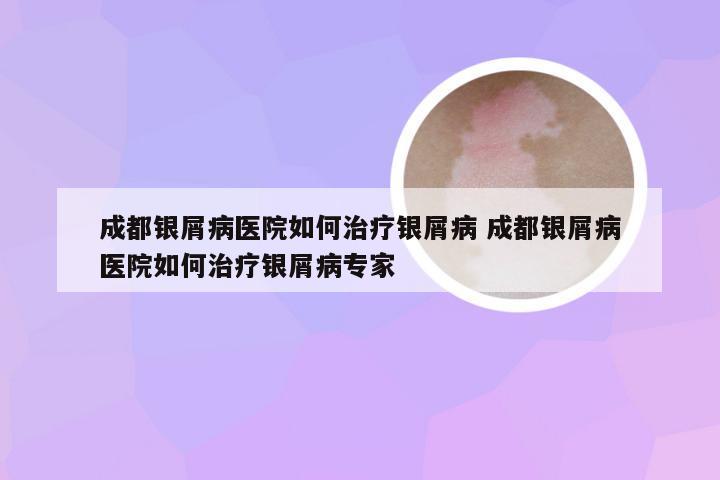成都银屑病医院如何治疗银屑病 成都银屑病医院如何治疗银屑病专家