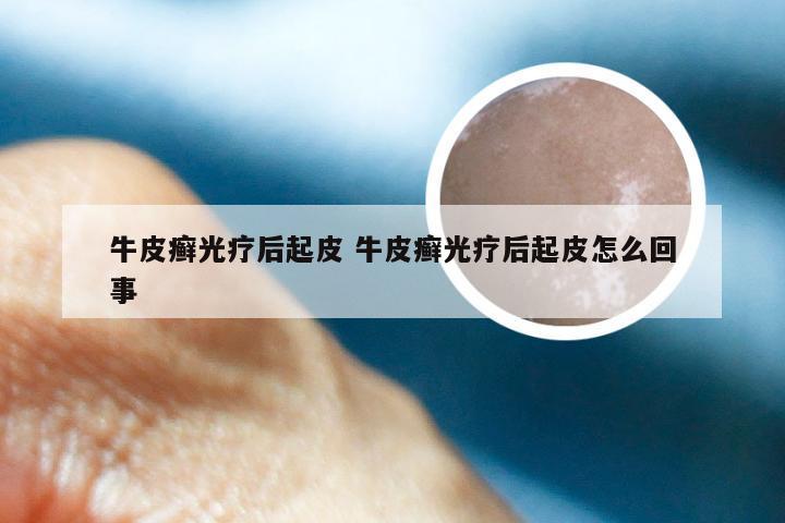 牛皮癣光疗后起皮 牛皮癣光疗后起皮怎么回事