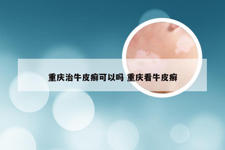 重庆治牛皮癣可以吗 重庆看牛皮癣