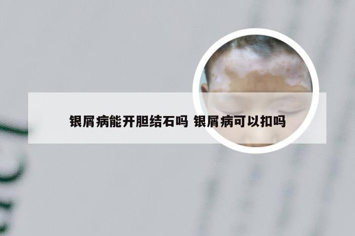 银屑病能开胆结石吗 银屑病可以扣吗