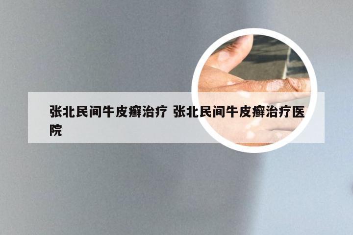 张北民间牛皮癣治疗 张北民间牛皮癣治疗医院