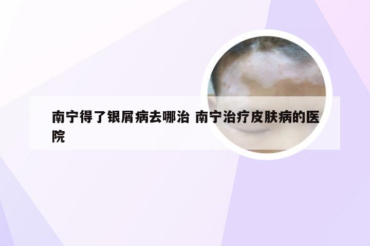 南宁得了银屑病去哪治 南宁治疗皮肤病的医院
