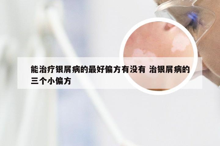 能治疗银屑病的最好偏方有没有 治银屑病的三个小偏方