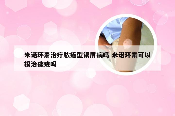 米诺环素治疗脓疱型银屑病吗 米诺环素可以根治痤疮吗