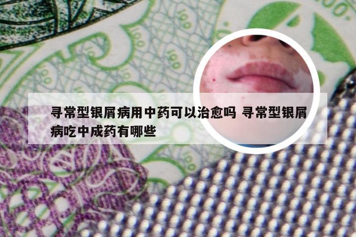 寻常型银屑病用中药可以治愈吗 寻常型银屑病吃中成药有哪些