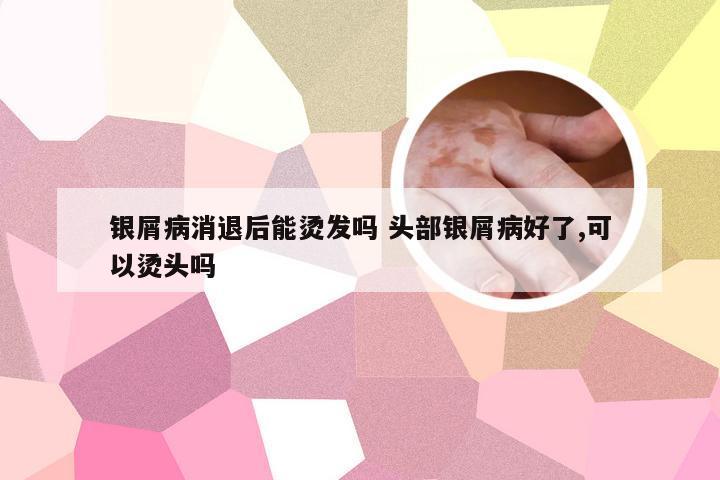 银屑病消退后能烫发吗 头部银屑病好了,可以烫头吗