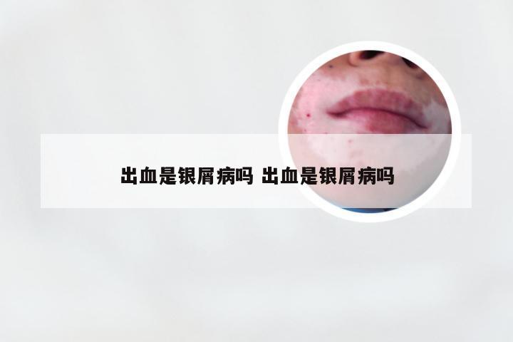 出血是银屑病吗 出血是银屑病吗