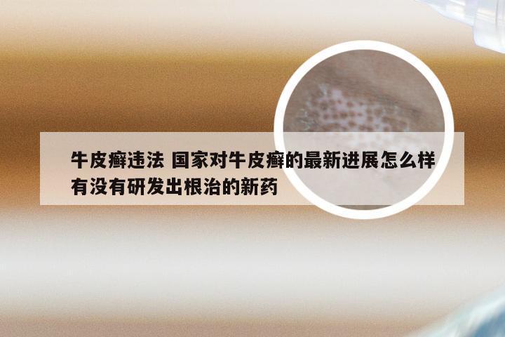 牛皮癣违法 国家对牛皮癣的最新进展怎么样有没有研发出根治的新药