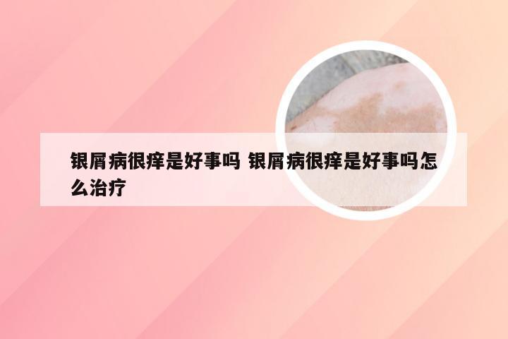 银屑病很痒是好事吗 银屑病很痒是好事吗怎么治疗
