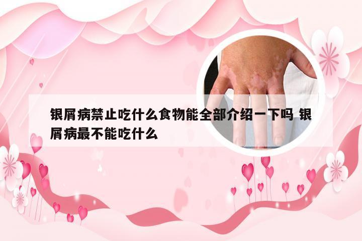 银屑病禁止吃什么食物能全部介绍一下吗 银屑病最不能吃什么