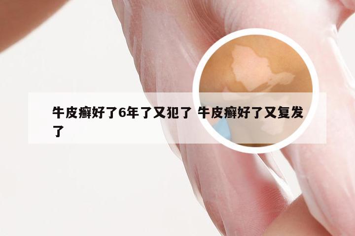 牛皮癣好了6年了又犯了 牛皮癣好了又复发了