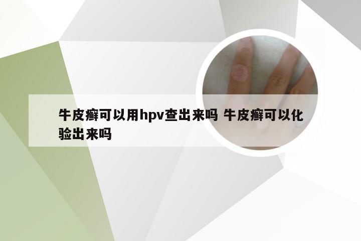 牛皮癣可以用hpv查出来吗 牛皮癣可以化验出来吗