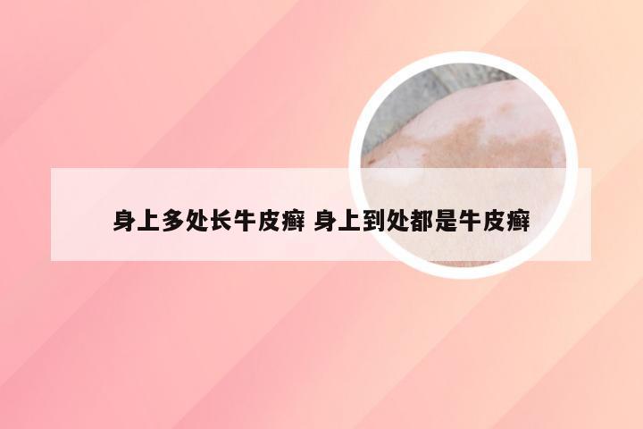 身上多处长牛皮癣 身上到处都是牛皮癣