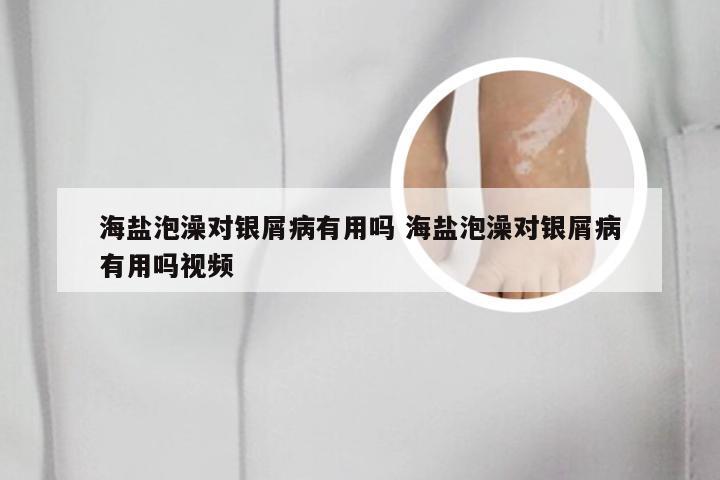 海盐泡澡对银屑病有用吗 海盐泡澡对银屑病有用吗视频