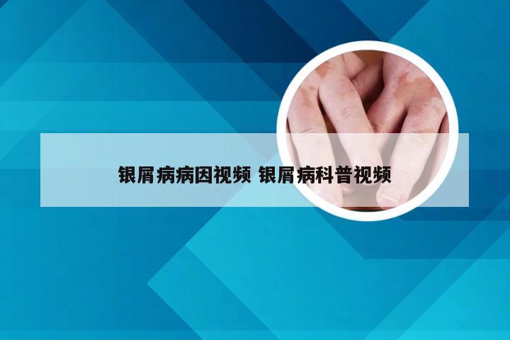 银屑病病因视频 银屑病科普视频