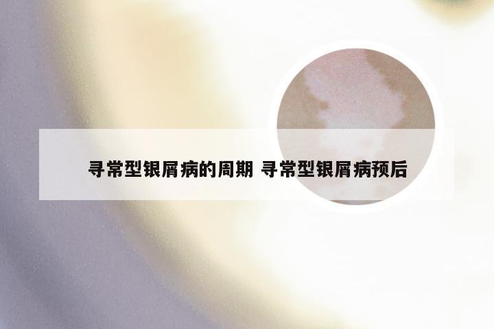 寻常型银屑病的周期 寻常型银屑病预后